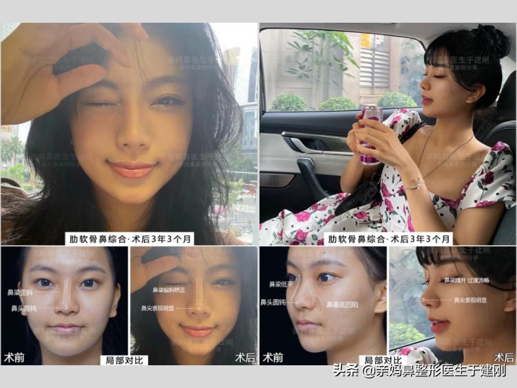 永久性的注射隆鼻 隆鼻可以维持多久