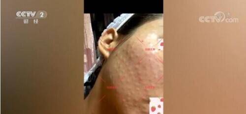 水光针副作用,太可怕了 美白针多久打一次