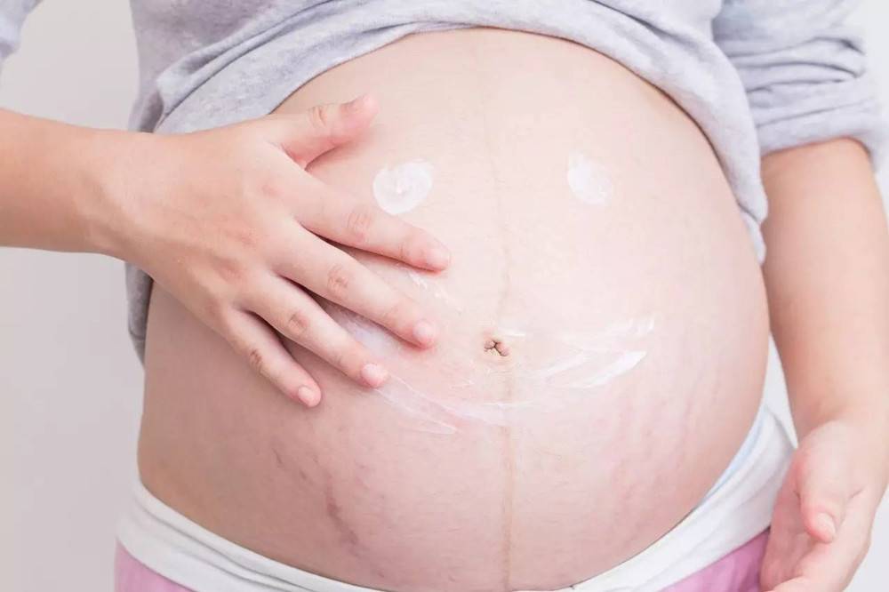 紫色妊娠纹多久颜色才会变淡 妊娠纹多久会消失