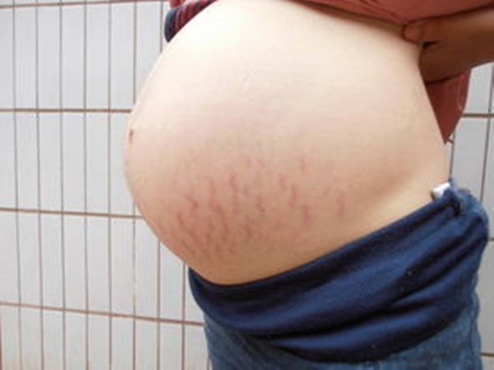 紫色妊娠纹多久颜色才会变淡 妊娠纹多久会消失