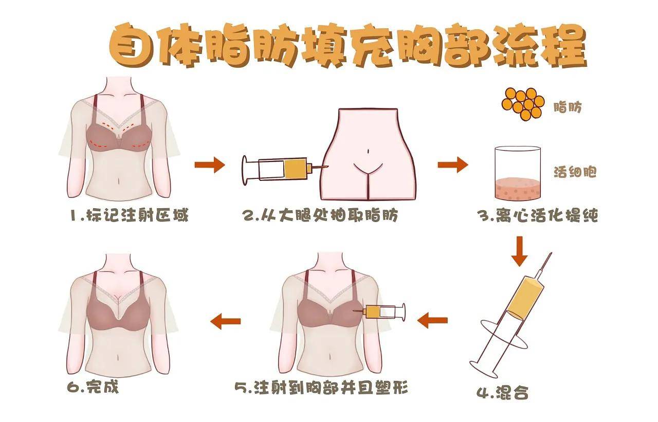 自体脂肪隆胸是终身吗 自体脂肪填充维持多久