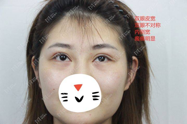 双眼皮失败两个月可以修复吗 失败双眼皮多久修复