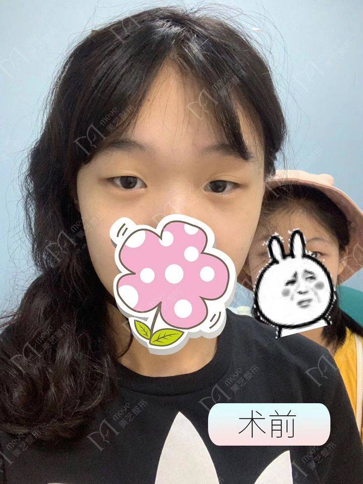 双眼皮失败两个月可以修复吗 失败双眼皮多久修复