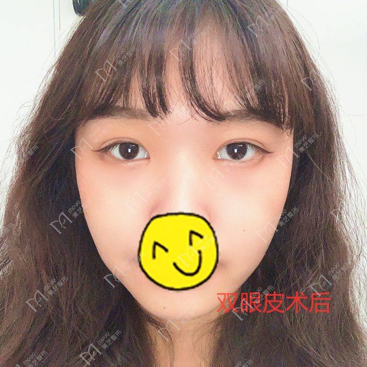 双眼皮失败两个月可以修复吗 失败双眼皮多久修复