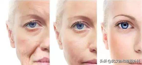 瘦脸针最多能维持多久 瘦脸针能坚持多久