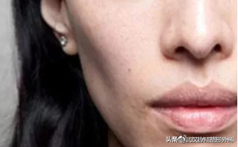 瘦脸针最多能维持多久 瘦脸针能坚持多久