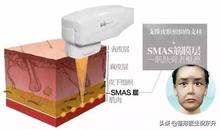 先做超声刀还是先做热玛吉 超声刀做多久