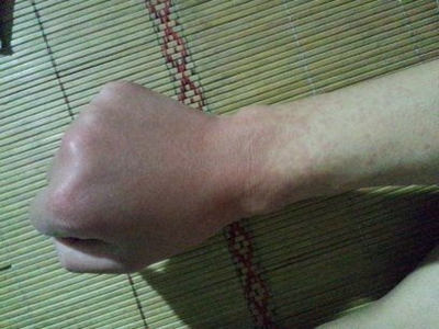 对油漆过敏的症状