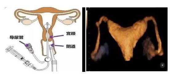 宫外孕保守治疗多久可以做造影 做造影多久可以怀孕