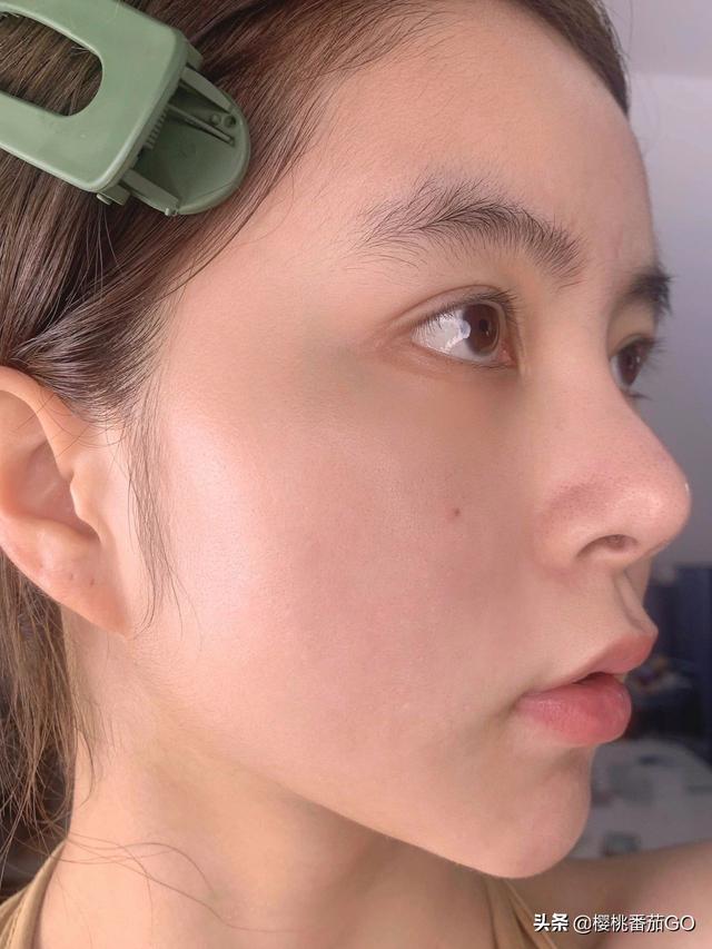有什么祛痘去痘印的方法?
