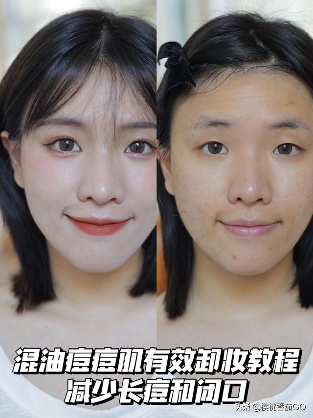 用过卸妆油后长痘了是怎么回事?