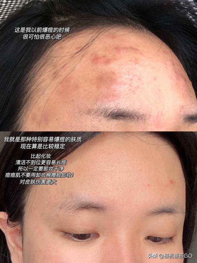 用过卸妆油后长痘了是怎么回事?