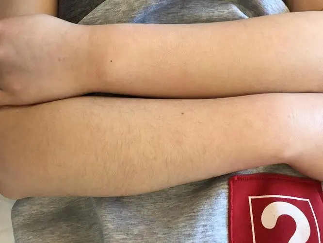 冰点脱毛10次了还是长毛