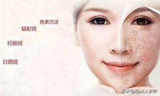 脸上的色斑是怎么长出来的?