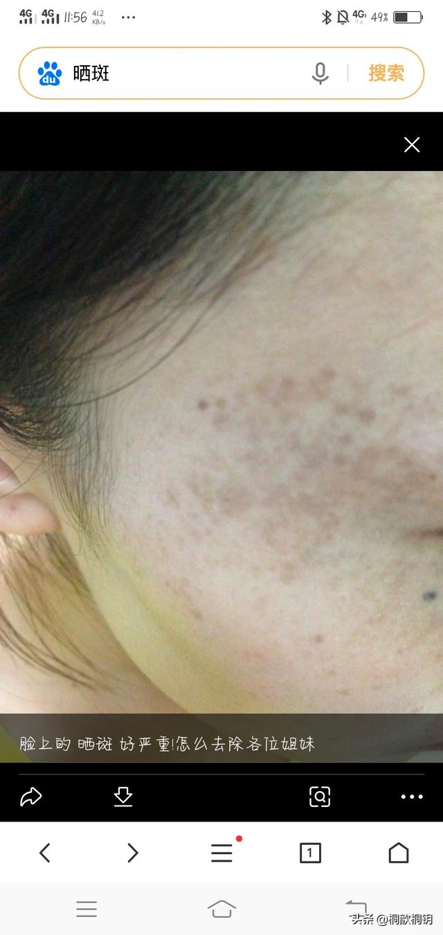 脸上的色斑是怎么长出来的?