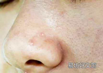 脸容易出油是油皮吗