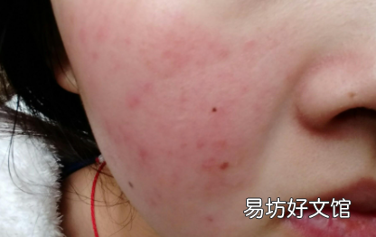 有红血丝去角质需要避开吗
