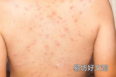 荨麻疹最怕三种东西