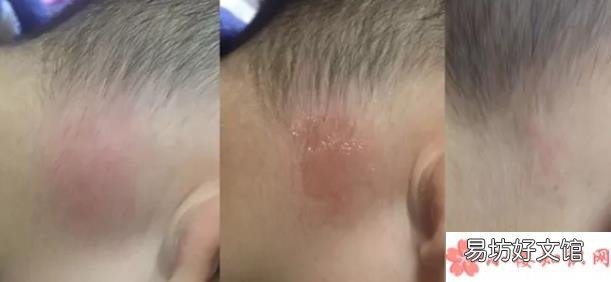 木瓜膏宝宝用了会过敏吗 宝宝用木瓜膏有副作用吗