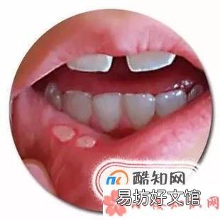 吃滾燙的食物會有哪些危害