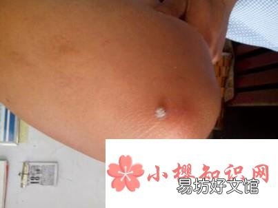 怎样去疣子有效