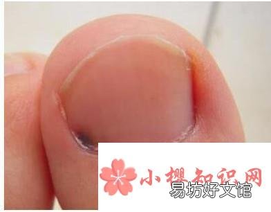 有了灰指甲,用花椒蒜醋液治好
