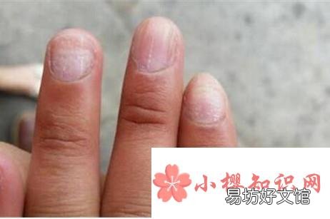 有了灰指甲,用花椒蒜醋液治好