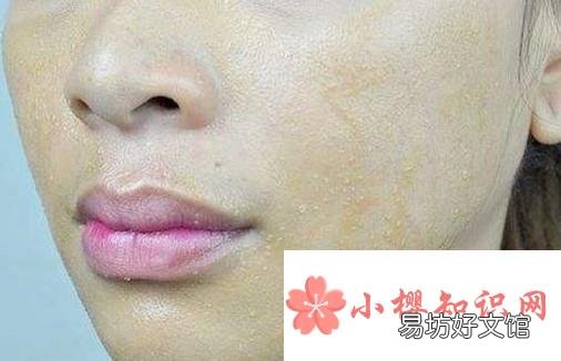 什么面膜去黑头最好