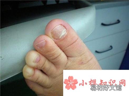 脚指甲变厚怎么办