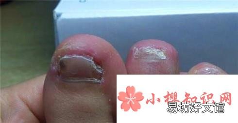 脚指甲变厚怎么办