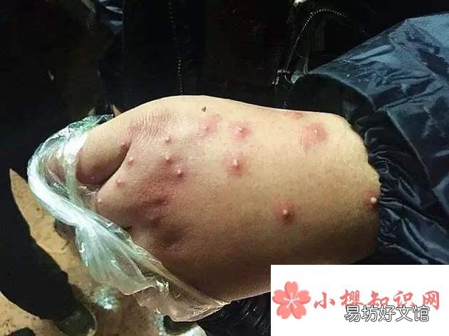 野外被虫子咬了怎么办?