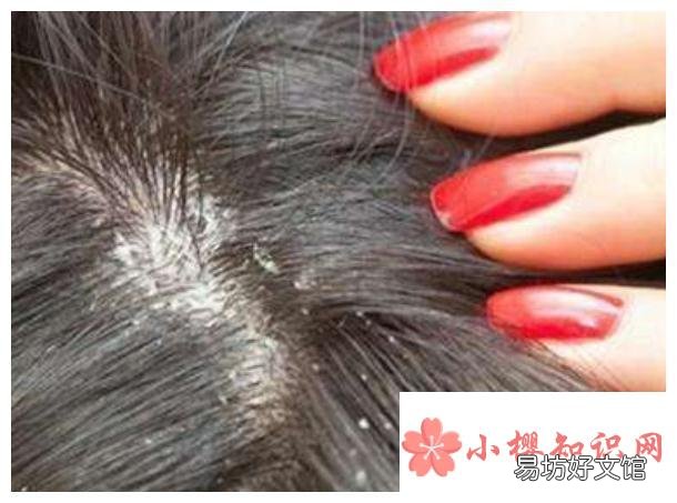 去除头上虱子的方法