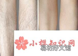 女生腿毛怎么永久去除
