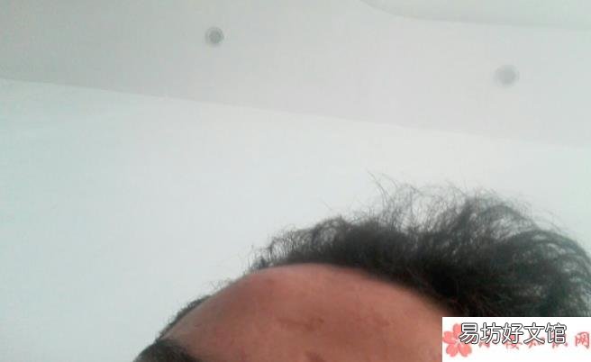 蚂蚁庄园3月24日正确答案 头被撞之后会起大包其他身体部位不会是因为什么