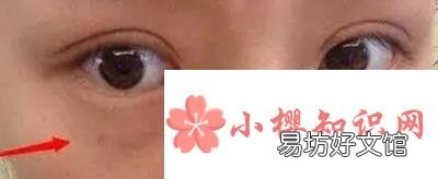 眼袋是怎样产生的？如何消除？