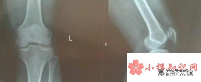判断骨骼闭合小方法有哪些?
