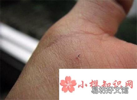 手上扎进小刺很疼却挑不出来怎么办?