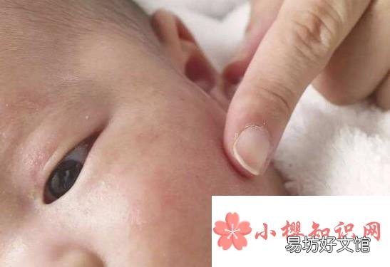 防治宝宝长痱子的方法有哪些？长痱子该怎么办
