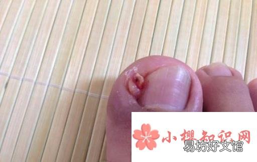 指甲长到肉里怎么办