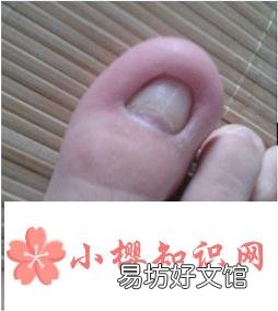 指甲长到肉里怎么办