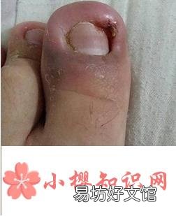 指甲长到肉里怎么办