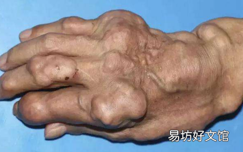 为什么胖的人一瘦下来就痛风