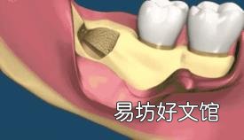 最难拔的智齿图 怎么拔智齿