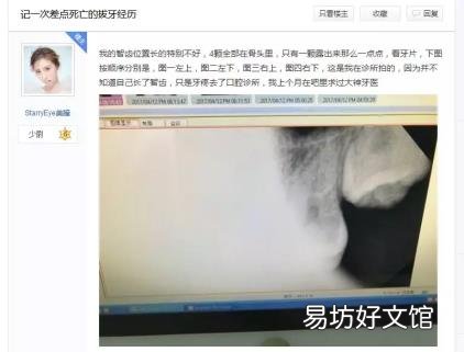 最难拔的智齿图 怎么拔智齿