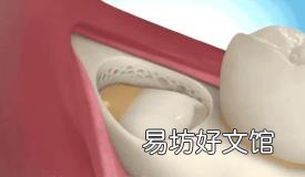 最难拔的智齿图 怎么拔智齿