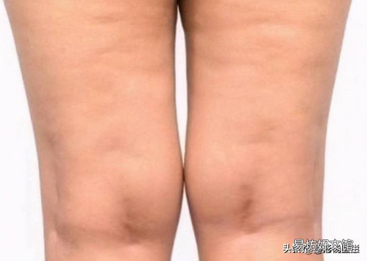脸太瘦凹进去怎么办 脸太瘦凹进去怎么增肥
