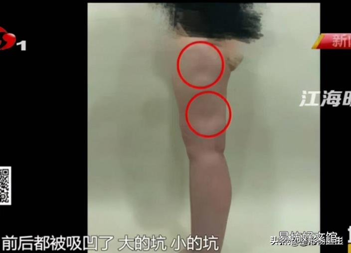 脸太瘦凹进去怎么办 脸太瘦凹进去怎么增肥