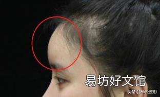 脸太瘦凹进去怎么办 脸太瘦凹进去怎么增肥
