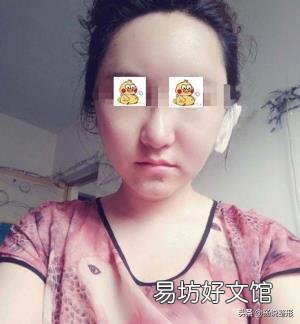 脸太瘦凹进去怎么办 脸太瘦凹进去怎么增肥