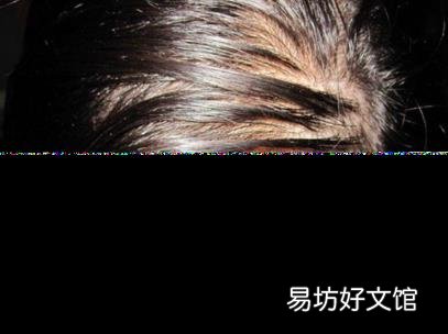 头上出油厉害是为什么 头上出油厉害怎么办